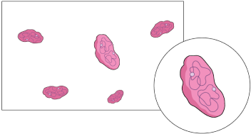 Graphic showing how red blood cells look with IDA, less hemoglobin in each cell