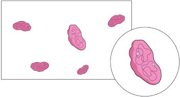 Graphic showing how red blood cells look with IDA, less hemoglobin in each cell